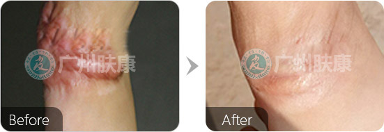 广州肤康皮肤病医院