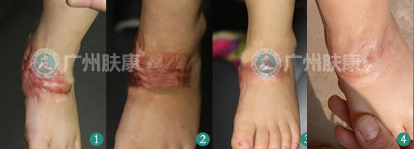 广州肤康皮肤病医院