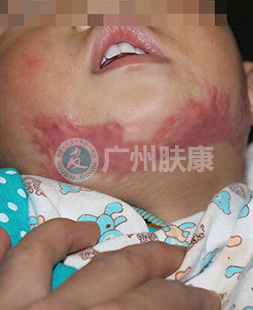 广州肤康皮肤病医院