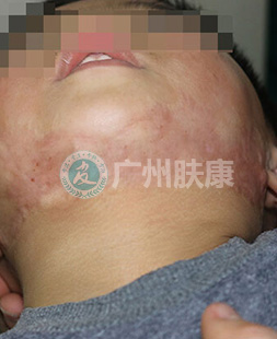 广州肤康皮肤病医院