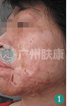 广州肤康皮肤病医院