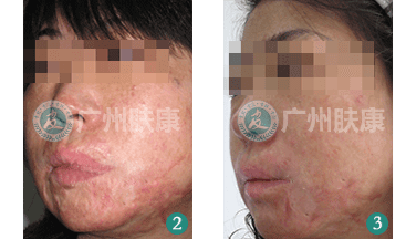 广州肤康皮肤病医院