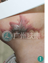 广州肤康皮肤病医院