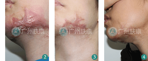 广州肤康皮肤病医院