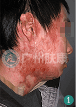 广州肤康皮肤病医院