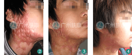 广州肤康皮肤病医院