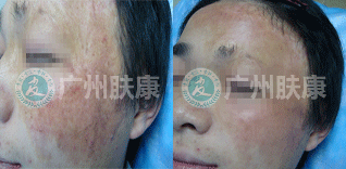 广州肤康皮肤病医院