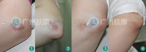 广州肤康皮肤病医院