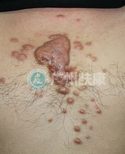 广州肤康皮肤病医院