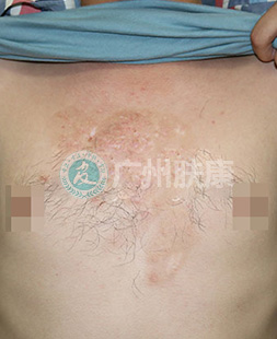 广州肤康皮肤病医院