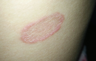 广州肤康皮肤病医院